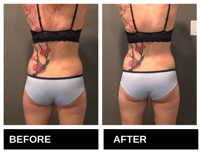 Lipo Laser Birmingham AL Before & After 2