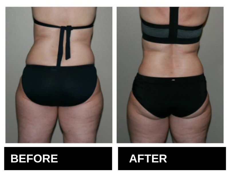 Lipo Laser Birmingham AL Before & After 3