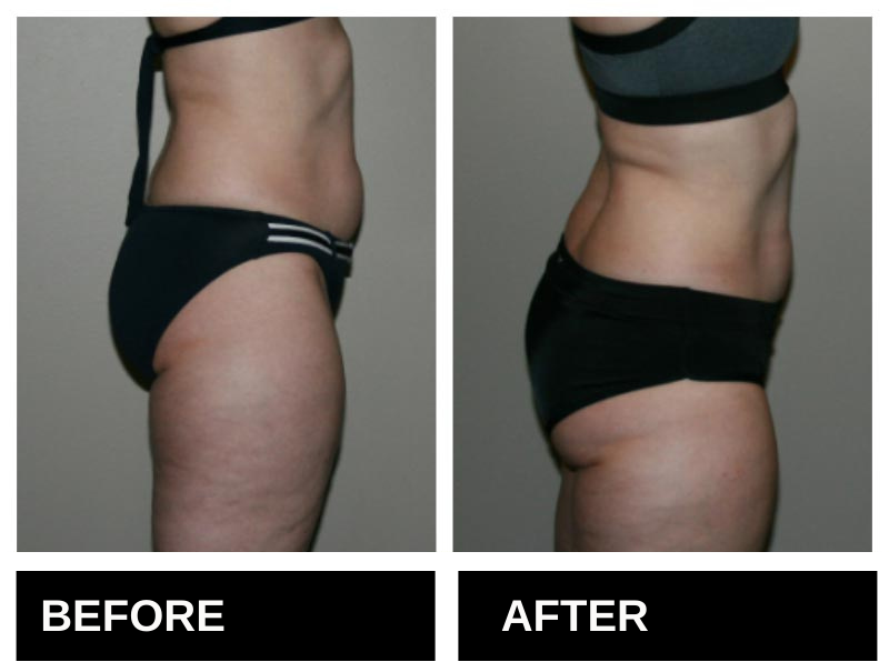 Lipo Laser Birmingham AL Before & After 4