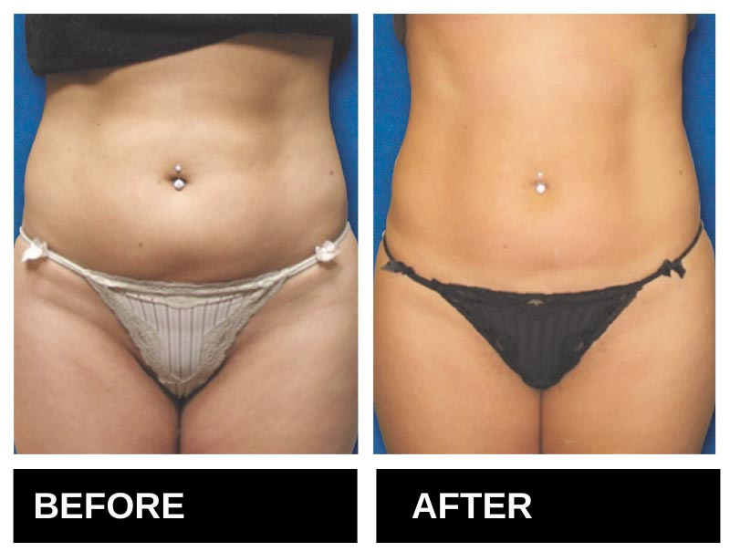 Lipo Laser Birmingham AL Before & After the 10