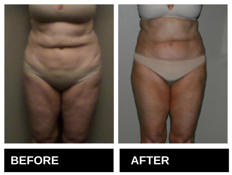 Lipo Laser Birmingham AL Before & After 6