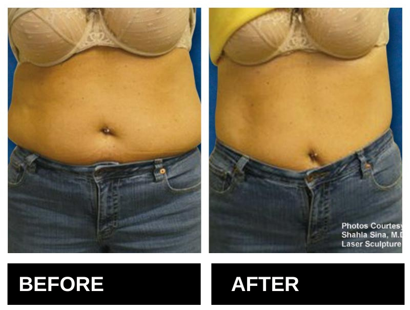 Lipo Laser Birmingham AL Before & After 8