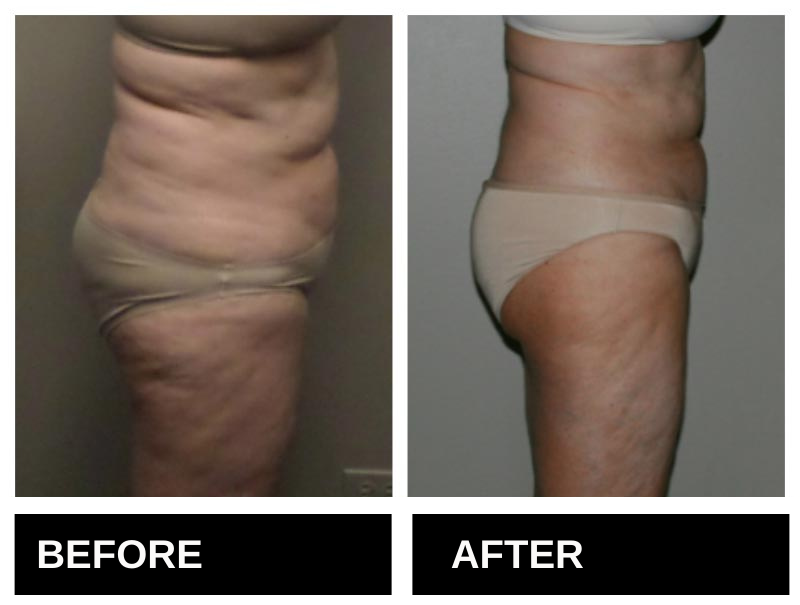 Lipo Laser Birmingham AL Before & After 7