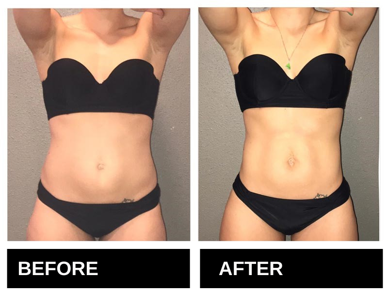 Lipo Laser Birmingham AL Before & After 9